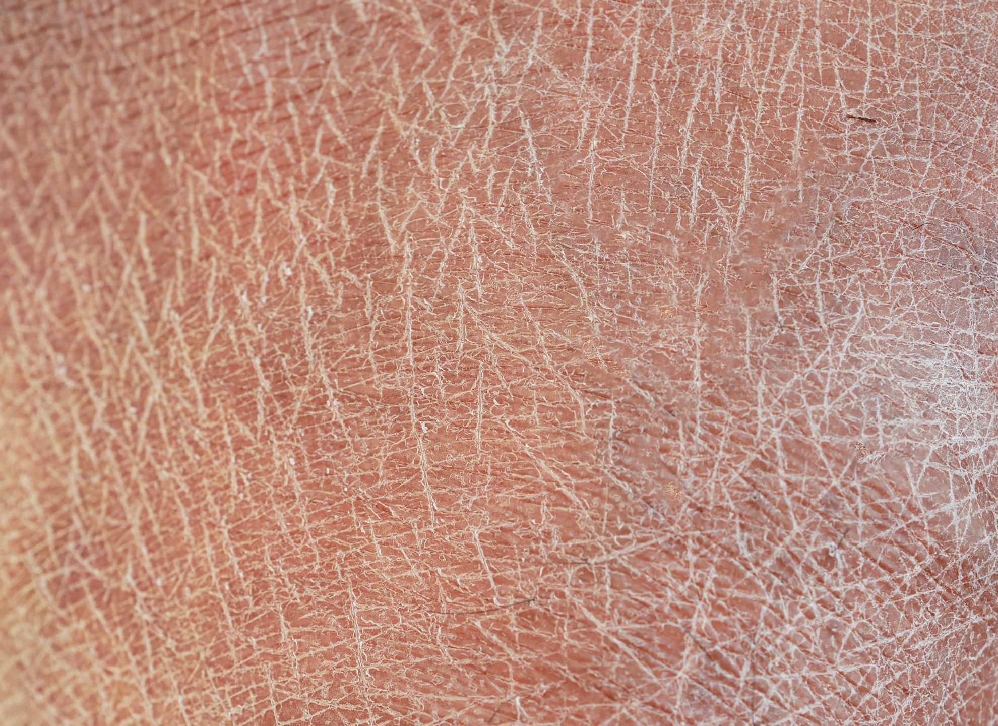 ผิวขาดน้ำ